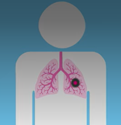 Coventry & Warwickshire Lung Cancer Screening